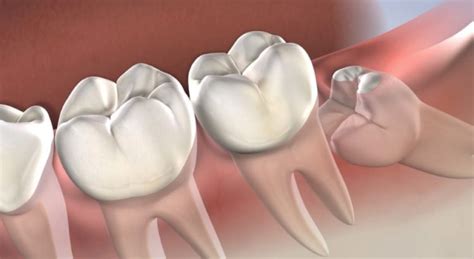 Check with your dentist, surgeon, and insurance provider on your benefits and what will be covered. How Medicare Works with Wisdom Teeth Removal | Sydney CBD Dentistry