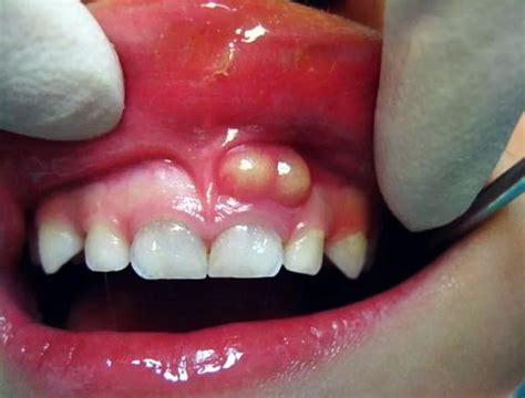 The 5 Abscess Tooth Stages And The Actions You Should Take