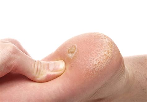Calluses Symptoms And Treatments Red Mountain Footcare