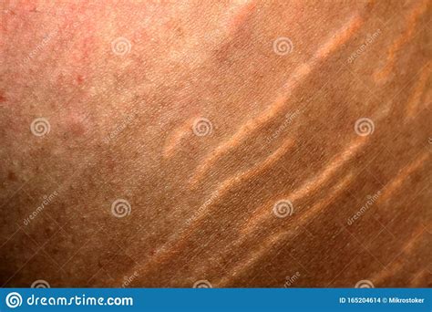 Stretch Marks On The Skin Scars On The Skin Stock Photo Image Of