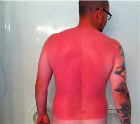 This Guy S Sunburn Is So Bad It Glows And You Should Wear Sunscreen