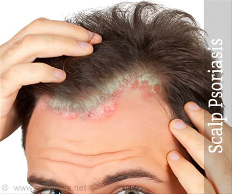 Hair Loss Scalp Psoriasis Folliculitis Scalp Symptoms Pictures