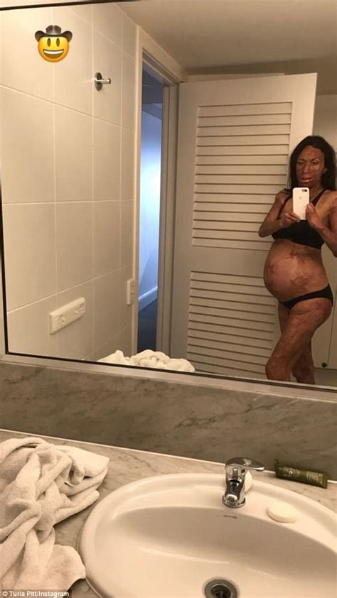 Burns Survivor Turia Pitt Shows Her Baby Bump On Instagram Express Digest