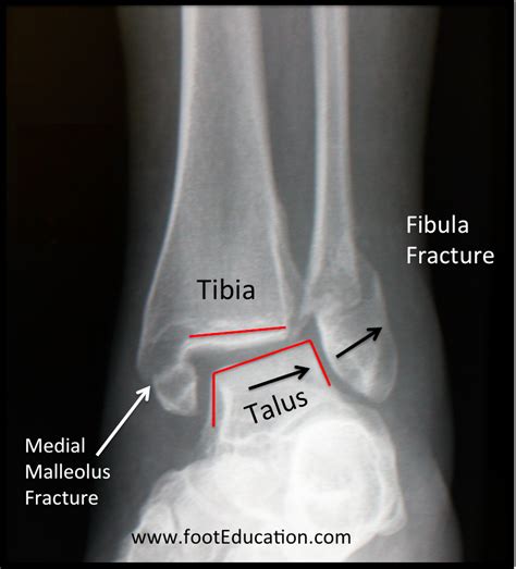 Ankle Fracture Footeducation