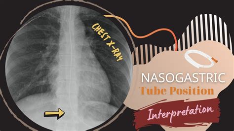 Chest X Ray Nasogastric Tube Position Interpretation Youtube