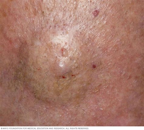 Cutaneous B Cell Lymphoma Disease Reference Guide