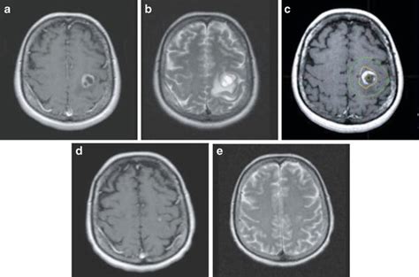 Metastatic Brain Tumors Radiology Key