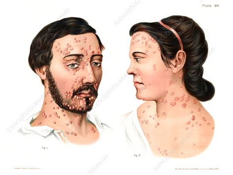 Secondary Syphilis Rash Illustration Stock Image C0308439