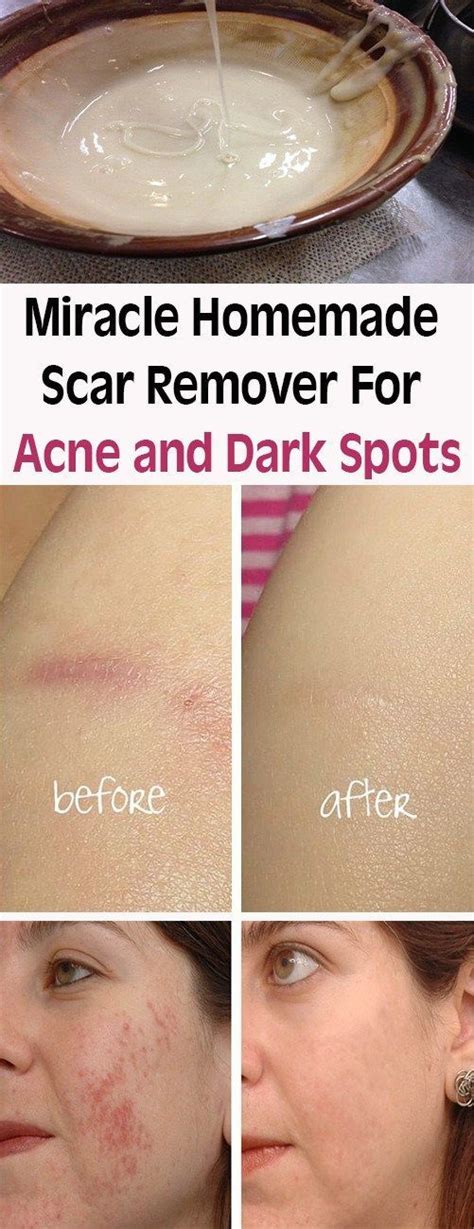 Miracle Homemade Scar Remover For Acne And Dark Spots Lets Tallk
