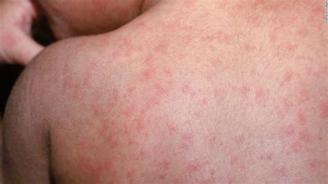 78 New Measles Cases Reported Nationwide Since Last Week Cdc Says
