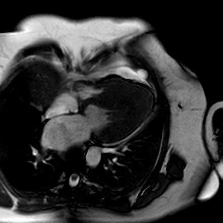 Apical Hypertrophic Cardiomyopathy Radiology Reference Article