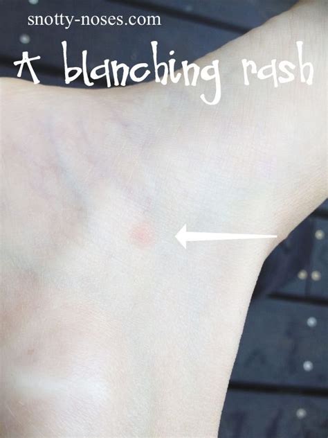 Blanching And Non Blanching Rashes