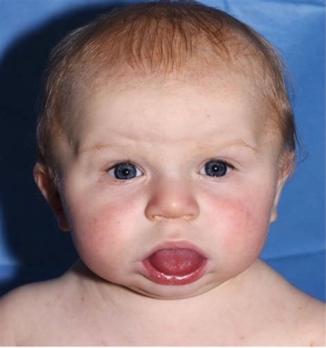 Infant With Macroglossia Adc Education And Practice Edition