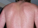 How to Tell if a Rash Needs Medical Attention | Alaska Native News