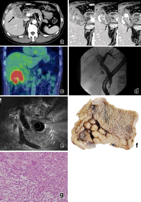 We Performed Subtotal Cholecystectomy For Xanthogranulomatous