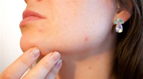 Have You Popped A Pimple Heres What You Should Do Next Life Style