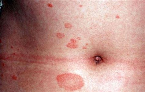 Introduction To Pityriasis Rosea Possible Causes Symp