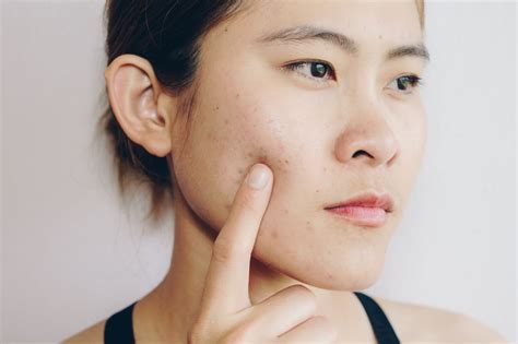 Acne Scars Your Treatment Options American Board Of Facial Cosmetic