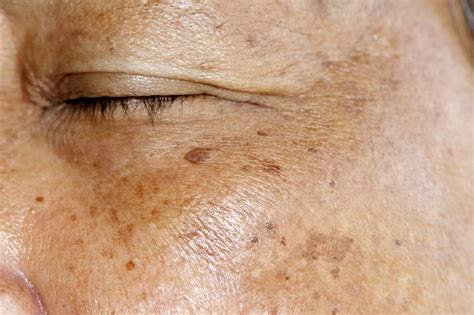 How to cure melasma from the inside home remedies. How to Treat Hyperpigmentation, Age Spots, & Melasma