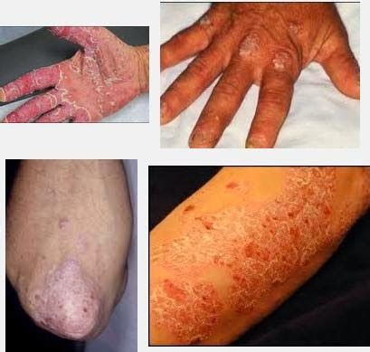 Hindari penggunaan produk perawatan kulit berbahan keras yang bisa menyebabkan iritasi. Kulit Gatal Kering Dan Berkerak Di Tangan