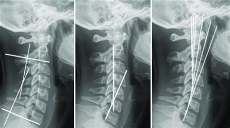 Lateral Cervical Radiographs With Lines Showing The Method Of Measuring