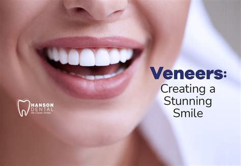 Veneers Creating A Stunning Smile Hanson Dental Dentist In Buffalo Mn