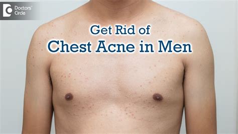 All About Pimples On Male Chest Chest Acnecauses And Best Cure Dr