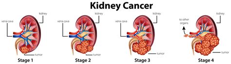 Diagram Showing Different Stages Of Kidney Cancer 292272 Vector Art At