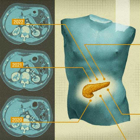 Oncology Catching Pancreatic Cancer Early