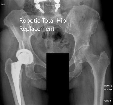 Ortho Total Hip Replacement X Ray Mso Physiotherapy