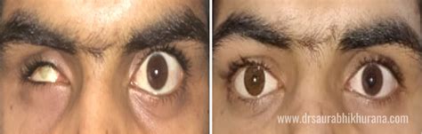 Eye Removal And Restoration Dr Saurbhi Khurana