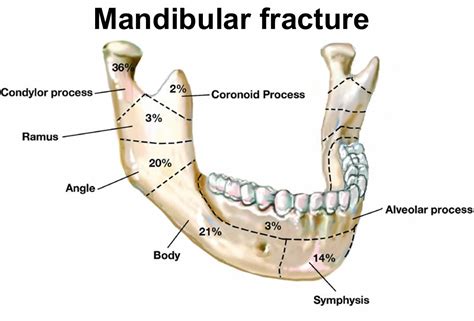 Facial Fractures Causes Types Symptoms Diagnosis Treatment Recovery