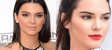 Kendall Jenner Lip Injection Plastic Surgery Before And After Lips
