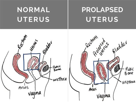 Is Surgery My Best Option For Prolapse Revitalize Physical Therapy