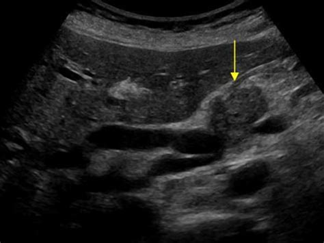 Pancreatic Adenocarcinoma Ultrasound