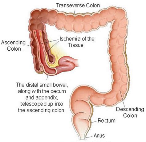 Bowel Obstruction Small Large Causes Symptoms Treatment