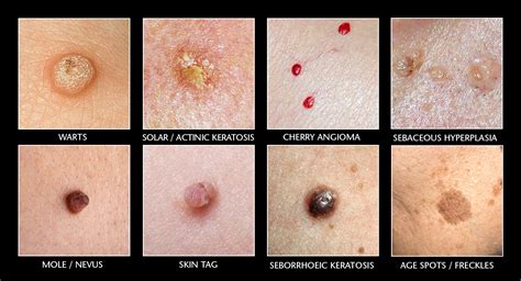 Cryotherapy Cost Melbourne Skin Tag And Wart Removal Melbourne