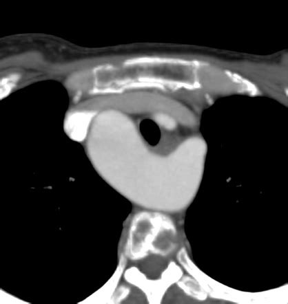 Right Sided Aortic Arch With Aberrant Left Subclavian Artery