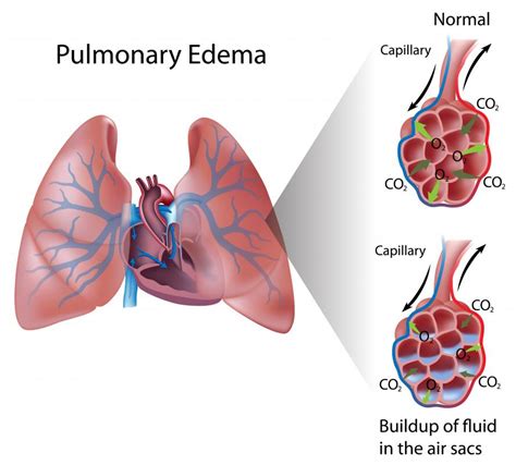 What Is The Pathophysiology Of Edema With Pictures