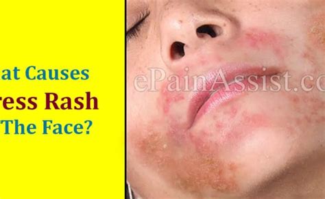 Stress Rash Causes Symptoms Pictures Treatment Otosection