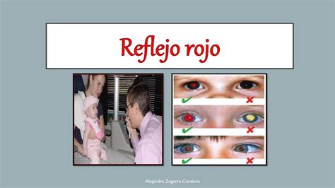 Reflejo Rojo Retiniano Test De Bruckner Diapositivas Medicina Udocz