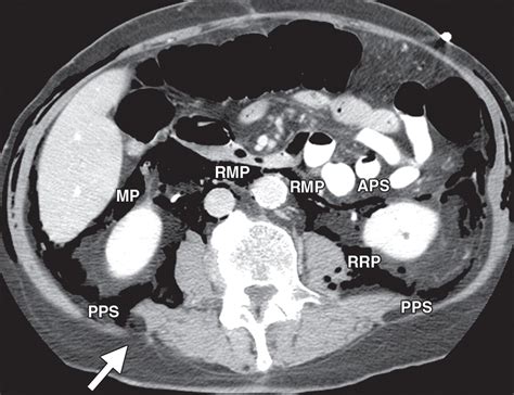 Peritoneal And Retroperitoneal Anatomy And Its Relevance For Cross