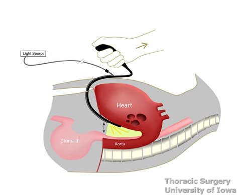 A single incision is made from the chest to the abdomen on the left side, and an incision is made in the neck. Arshava transhiatal retractor | Iowa Head and Neck Protocols