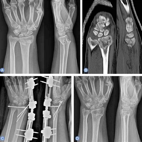 12 Preoperative X Rays Showing Comminuted Fracture Of Distal Radius