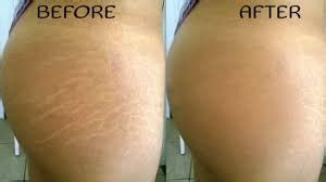 How Do I Get Rid Of Stretch Marks Vitality Laser Spa Can Help You