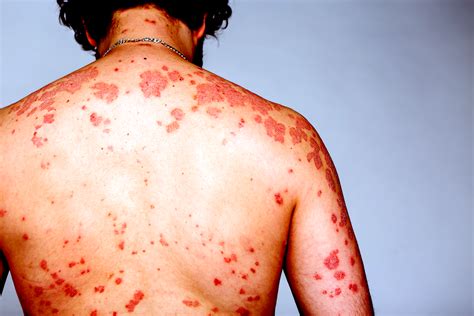 Acute Hiv Infection Symptoms