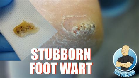 How To Treat Difficult Plantar Warts Removal Foot Health Month 2018