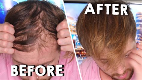How To Instantly Thicken Your Thinning Hair Battling Hair Loss Youtube