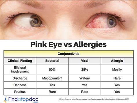 Pink Eye Vs Allergies Causes Symptoms And Treatment