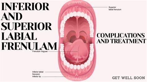 Inferior And Superior Labial Frenulum Complications And Treatment